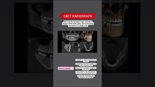 Importance of CBCT Radiographs in dentistry [upl. by Tasia]