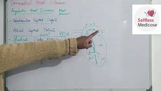 FCPS part 1CVS lecture 20 ACYANOTIC HEART DISEASES made easy [upl. by Eromle]