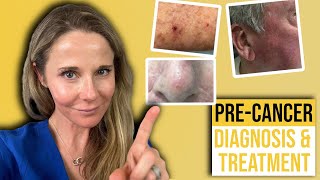 Actinic keratosis treatment guide from a Dermatologist [upl. by Imogene]