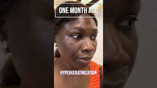 Meet Ms Adeola 🤩✨ who tackled HyperMelanosis with our Hyperpigmentation Treatment Protocol HTP✨ [upl. by Sapphira]