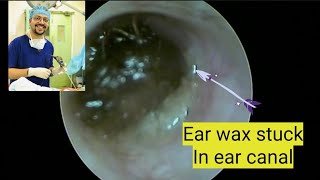 ear wax removal using suction forceps [upl. by Schifra]