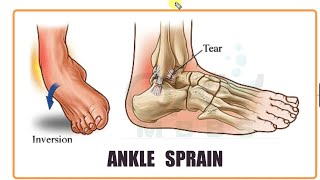 ORTHOPAEDICS Ankle Sprain [upl. by Anait]