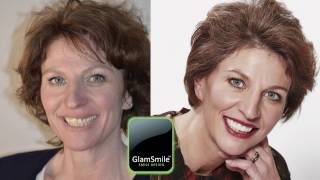 Nancy vertelt over haar ervaring met porseleinen facings van GlamSmile [upl. by Dorris]