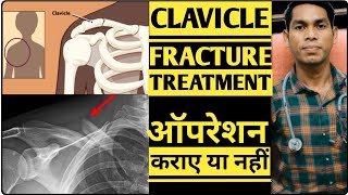 Clavicle bone fracture recovery time haddi kitne din me thik hota hai collar bone treatment hindi [upl. by Netnerb48]