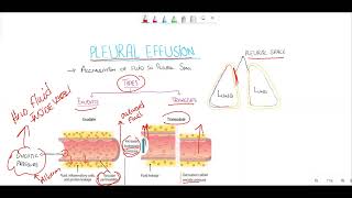 Pleural effusionTransudate vs exudate Light criteria [upl. by Zuleika]