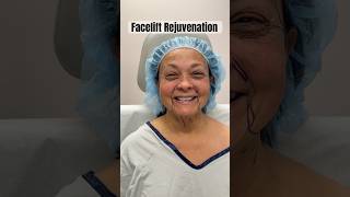 Patient Looks Years Younger After Facelift [upl. by Reuven537]