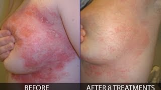 How to treat psoriasis effectively  By Franziska Ringpfeil Board Certified Dermatologist [upl. by Meador]