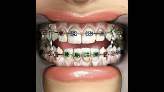 Orthodontic treatment dental dentist teeth dentalhealth dentalhygiene orthodontist smile [upl. by Cristal]