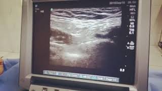 US guided genitofemoral nerve block [upl. by Alexandre142]