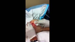 MRSA abscesses extraction [upl. by Yrolam682]