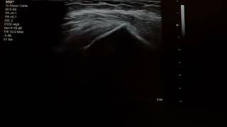 subacromial bursitis injection 24110101 [upl. by Watt]