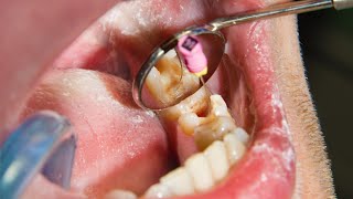 3D Animation What Happens During a Root Canal [upl. by Eilrebma508]