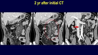 Mesenteric follicular lymphoma vs mesenteric panniculitis [upl. by Ecinue]