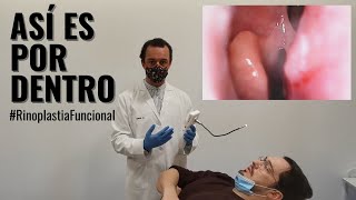 Rinoplastia Funcional para respirar bien Así se hace una Rinoscopia [upl. by Brufsky769]