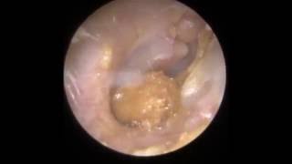 Ear Wax Removal Leicester  Mr Neel Raithatha The Hear Clinic [upl. by Ran]