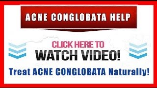 Acne Conglobata Help  Natural Treatment and Prevention [upl. by Anirtep]