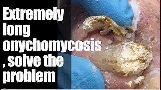 Extremely long onychomycosis solve the problemingrowntoenailremovalasmrRelaxing [upl. by Holloway]