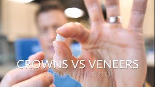 CROWNS VS VENEERS  Which is best [upl. by Atilehs373]