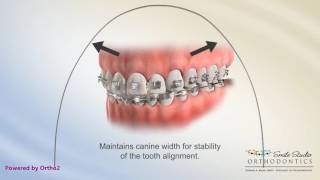 Damon Arch Form  Braces [upl. by Siuluj]