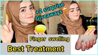 How To Treat Swollen Fingers At Home  Chilblains  Fingers Swelling in Winters  Dietitian Aqsa [upl. by Mercier]