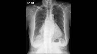 cardiomegaly CTpericardial effusion [upl. by Ingvar]