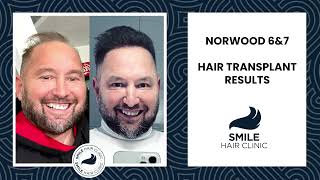 ADVANCED HAIR LOSS  NORWOOD 6amp7  HAIR TRANSPLANT RESULTS  BEFORE amp AFTER  SMILE HAIR CLINIC [upl. by Orly705]