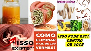 ELIMINE 100 VERMES RÁPIDO VÁRIOS TIPOS 7 RECEITAS CASEIRAS P VERMINOSE ADULTO E CRIANÇA [upl. by Hametaf909]