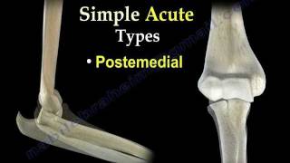 Elbow Dislocations  Everything You Need To Know  Dr Nabil Ebraheim [upl. by Attenaj517]