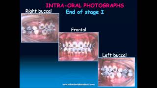 beggs technique part  orthodontic courses by Indian dental academy [upl. by Drofub]