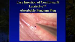 Inserting the Comfortear® Lacrisolve® 180 Absorbable Punctum Plug [upl. by Juliano687]