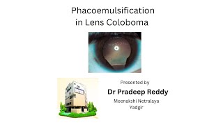 Meenakshi Netralaya Eye Hospital Yadgir Phacoemulsification in lens coloboma [upl. by Hershel]