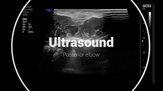 Olecranon bursitis and triceps insertional calcific enthesopathy thereportingroom [upl. by Eirffej]