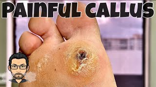 CALLUS REMOVAL FROM FEET [upl. by Voltz814]