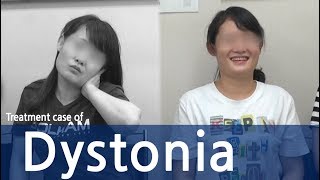 Cervical Dystonia Dystonia Spasmodic Torticollis  사경증 치료사례  근긴장이상증 [upl. by Ahseyk]