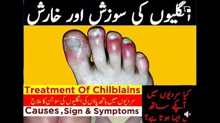 Chilblains  Treatment of Chilblains [upl. by Sawyor]