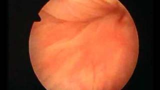 hysteroscopic aspect of adenomyosis [upl. by Gertie993]