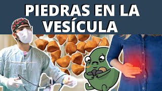 PIEDRAS EN LA VESÍCULA Colelitiasis  ¿POR QUÉ SALEN SÍNTOMAS TRATAMIENTO [upl. by Akinoj]