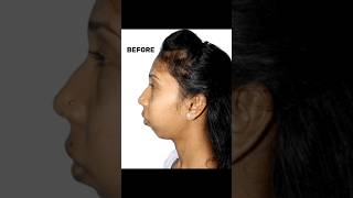 How To Correct Facial Asymmetry  Dr Parit Ladani [upl. by Llerrut]