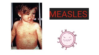 MEASLES Causes Pathology Symptoms Diagnosis Treatment Vaccination Care  What is Measles [upl. by Gayel]