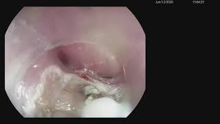 Zenkers Diverticulum and Endoscopic Cricopharyngeal Myotomy [upl. by Anaile]