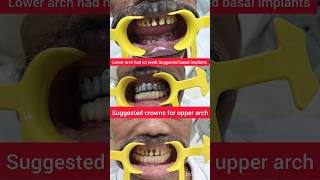 Fix Teeth in 5 days with Basal Implants PFM crowns for upper teeth given smilemakeover smile [upl. by Constantin]