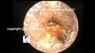 Care should be taken in case of cerumen with tympanic membrane perforation [upl. by Koorb]