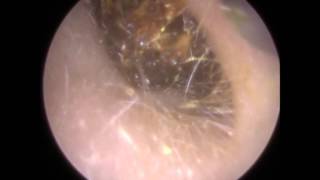 205 Ear Wax Teased and Wriggled out of Narrow Ear Canal  Mr Neel Raithatha THC [upl. by Markson]