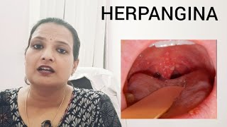 HERPANGINA throat ulcers in kids with high fever precautions and treatment [upl. by Bruning]