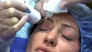 Thermage NYC Treatment by NY Cosmetic Dermatologist [upl. by Gniw208]