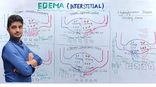 Interstitial Edema Pathology  Edema part 3 [upl. by Oreves790]