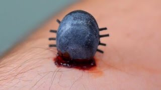 GIGANTIC TICK IN ARM [upl. by Lianna]