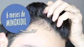 MINOXIDIL DEPOIS 6 MESES [upl. by Ahsienroc]