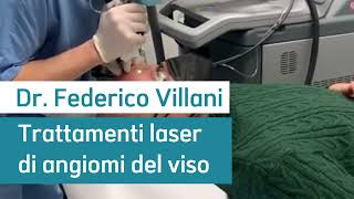 DEKA Laser  Trattamento degli angiomi del viso [upl. by Arbmat943]