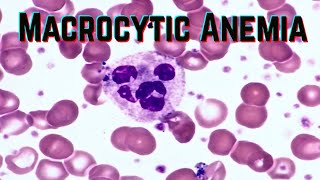 Macrocytic Anemia updated 2021  CRASH Medical Review Series [upl. by Nugent]